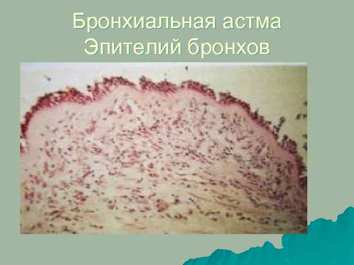 Бронхиальная астма Эпителий бронхов 