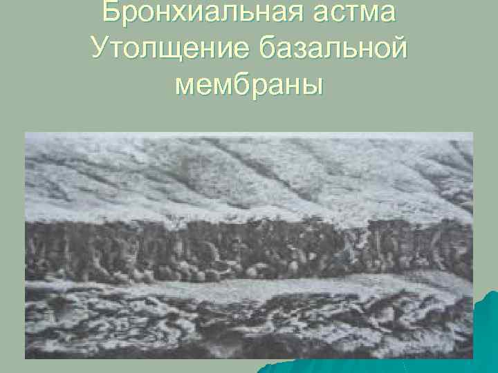 Бронхиальная астма Утолщение базальной мембраны 