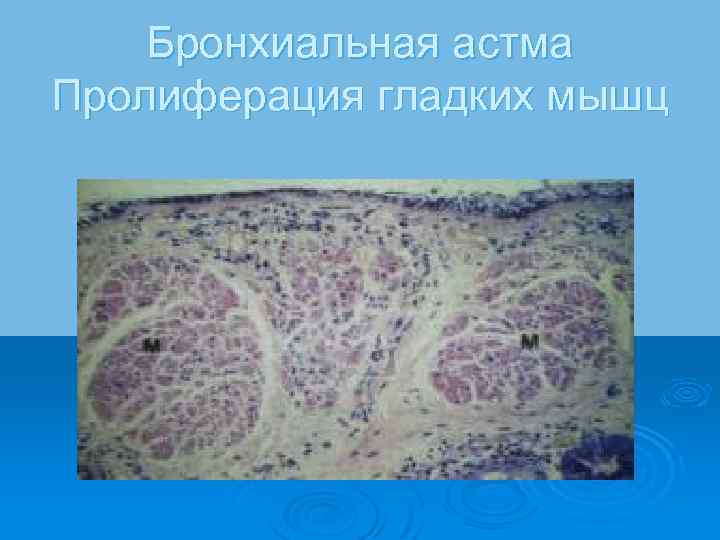 Бронхиальная астма Пролиферация гладких мышц 