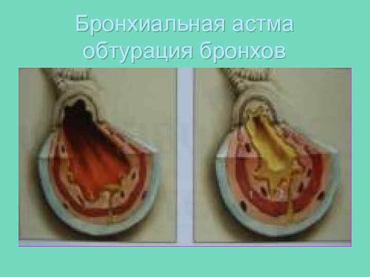 Бронхиальная астма обтурация бронхов 