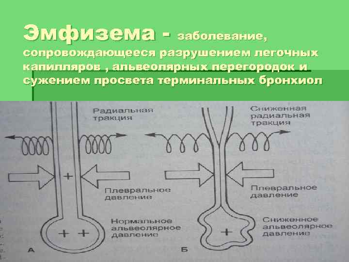 Эмфизема - заболевание, сопровождающееся разрушением легочных капилляров , альвеолярных перегородок и сужением просвета терминальных