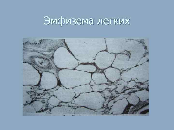 Эмфизема легких 