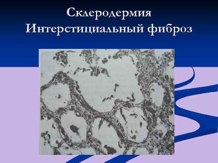 Склеродермия Интерстициальный фиброз 