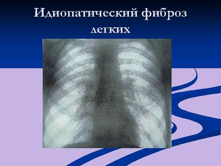 Идиопатический фиброз легких 