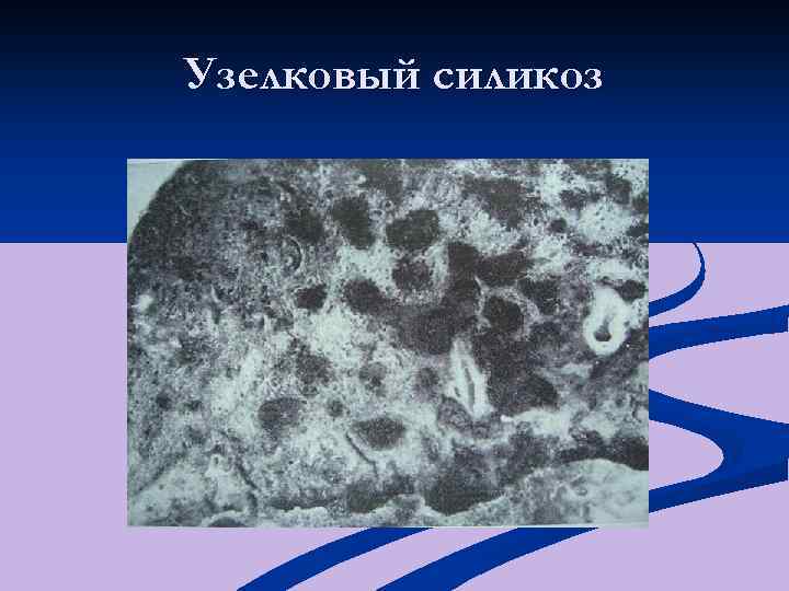 Узелковый силикоз 