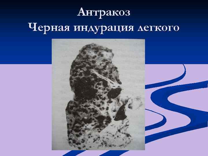 Антракоз Черная индурация легкого 