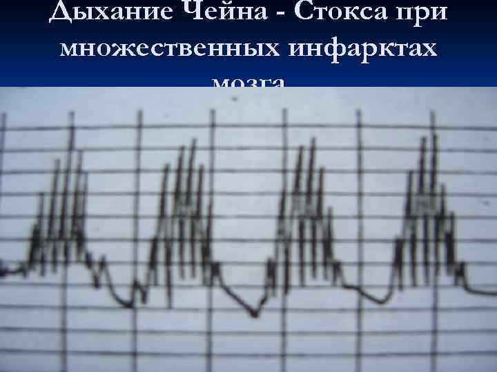 Дыхание Чейна - Стокса при множественных инфарктах мозга 