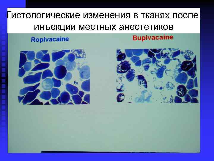 Гистологические изменения в тканях после инъекции местных анестетиков 