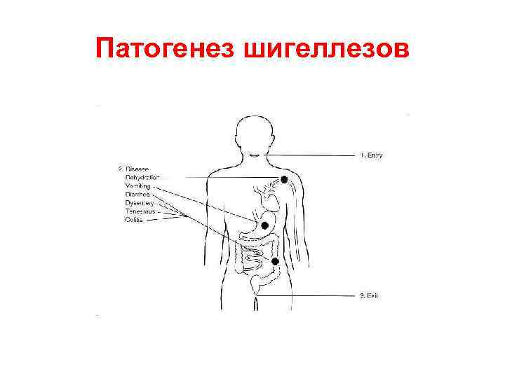 Патогенез шигеллезов 