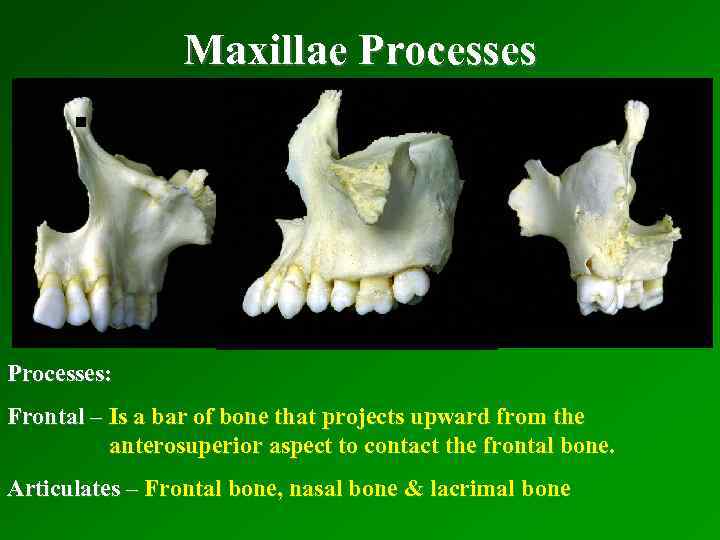 . Maxillae Processes: Frontal – Is a bar of bone that projects upward from