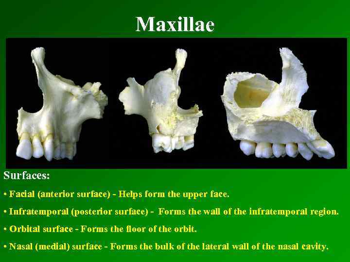 Maxillae Surfaces: • Facial (anterior surface) - Helps form the upper face. • Infratemporal