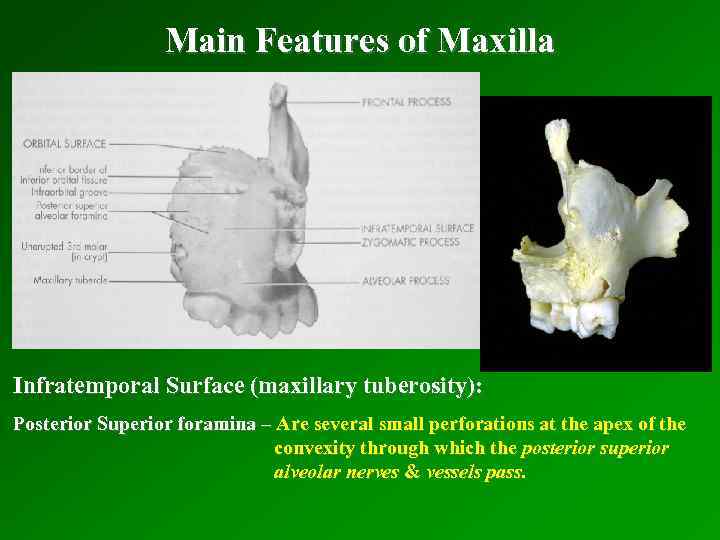 Main Features of Maxilla Infratemporal Surface (maxillary tuberosity): Posterior Superior foramina – Are several