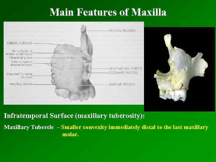 Main Features of Maxilla Infratemporal Surface (maxillary tuberosity): Maxillary Tubercle – Smaller convexity immediately