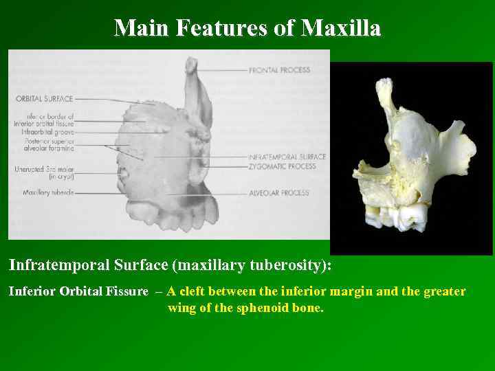Main Features of Maxilla Infratemporal Surface (maxillary tuberosity): Inferior Orbital Fissure – A cleft