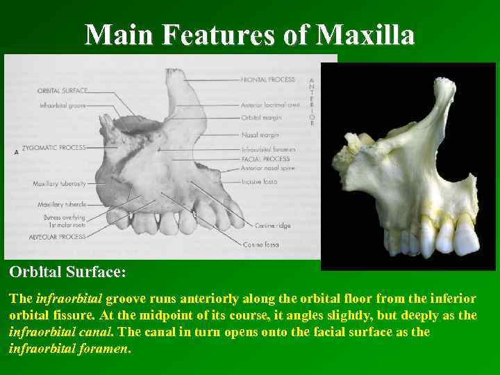 Main Features of Maxilla Orbital Surface: The infraorbital groove runs anteriorly along the orbital