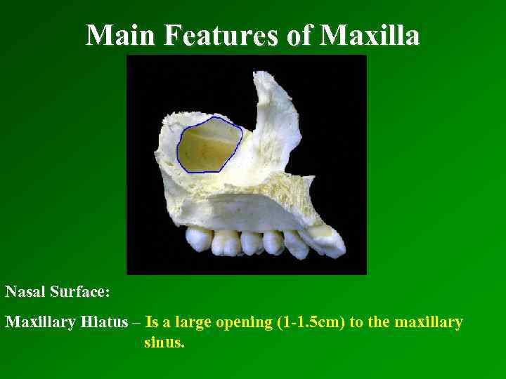 Main Features of Maxilla Nasal Surface: Maxillary Hiatus – Is a large opening (1