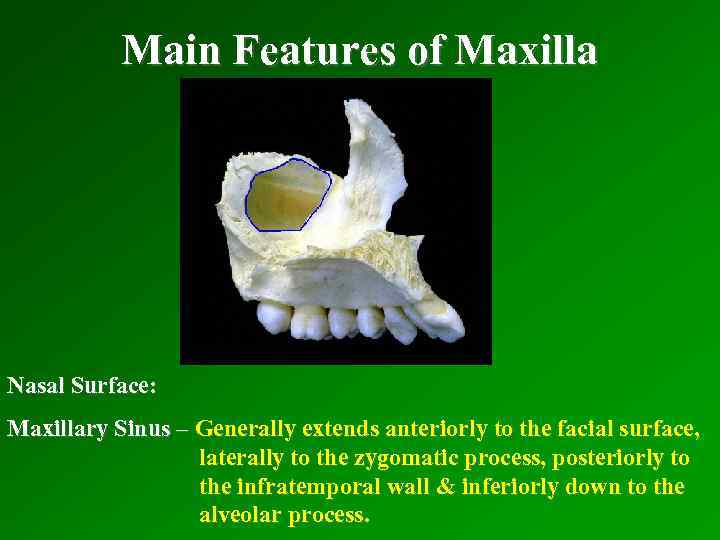 Main Features of Maxilla Nasal Surface: Maxillary Sinus – Generally extends anteriorly to the