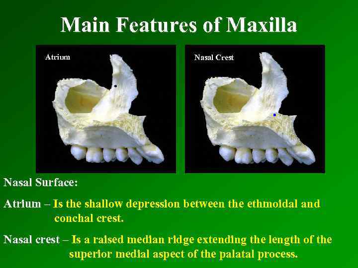 Main Features of Maxilla Atrium Nasal Crest Nasal Surface: Atrium – Is the shallow