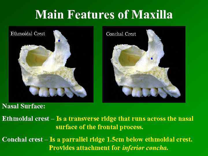 Main Features of Maxilla Ethmoidal Crest Conchal Crest Nasal Surface: Ethmoidal crest – Is
