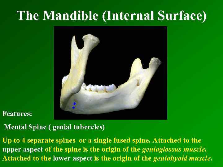 The Mandible (Internal Surface) Features: Mental Spine ( genial tubercles) Up to 4 separate
