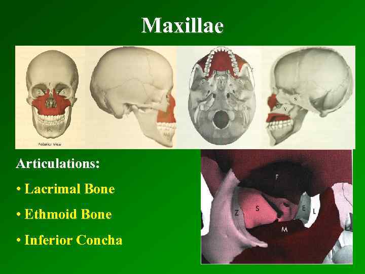Maxillae Articulations: • Lacrimal Bone • Ethmoid Bone • Inferior Concha 