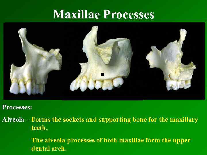 Maxillae Processes . Processes: Alveola – Forms the sockets and supporting bone for the