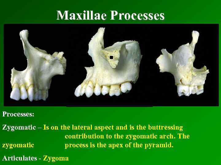 Maxillae Processes . Processes: Zygomatic – Is on the lateral aspect and is the