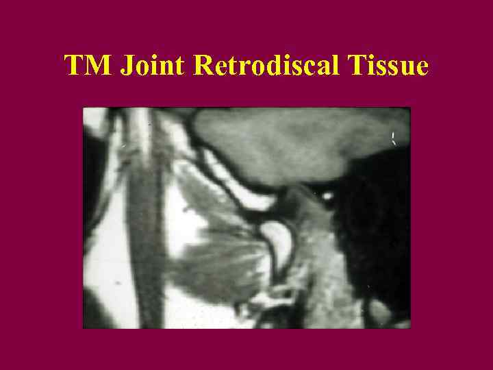 TM Joint Retrodiscal Tissue 