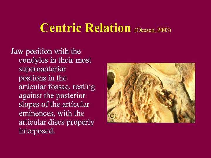 Centric Relation (Okeson, 2003) Jaw position with the condyles in their most superoanterior postions