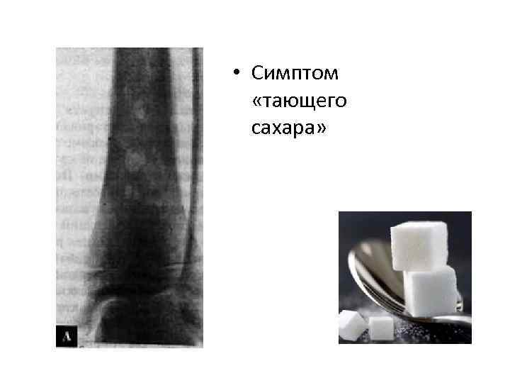  • Симптом «тающего сахара» 