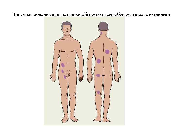 Типичная локализация натечных абсцессов при туберкулезном спондилите 