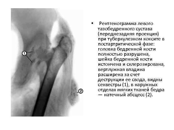  • Рентгенограмма левого тазобедренного сустава (переднезадняя проекция) при туберкулезном коксите в постартритической фазе: