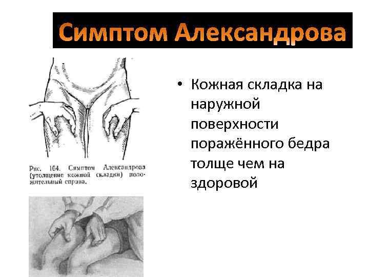  • Кожная складка на наружной поверхности поражённого бедра толще чем на здоровой 