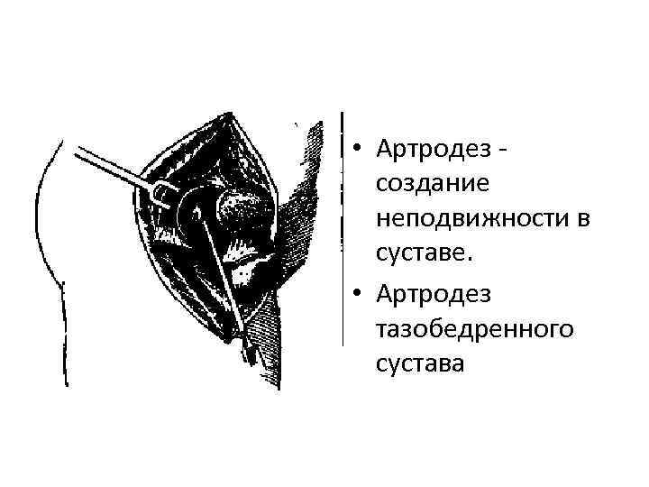  • Артродез создание неподвижности в суставе. • Артродез тазобедренного сустава 