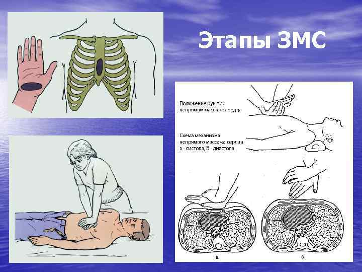 Реанимационные мероприятия непрямой массаж сердца и искусственное