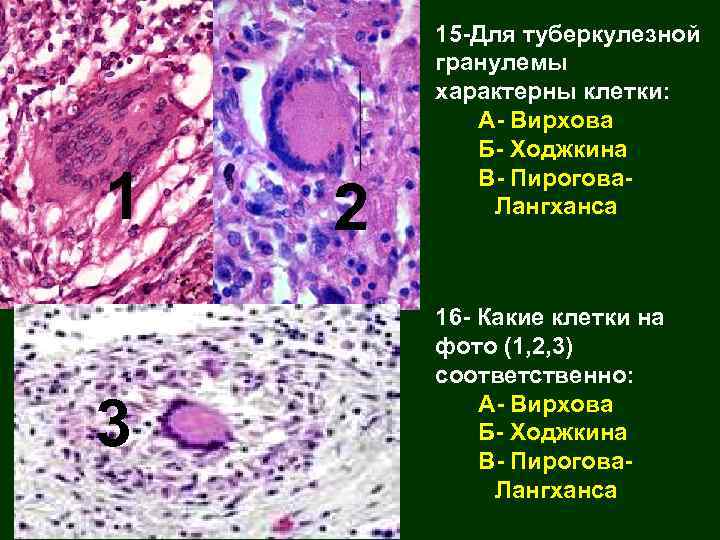 1 3 2 15 -Для туберкулезной гранулемы характерны клетки: А- Вирхова Б- Ходжкина В-