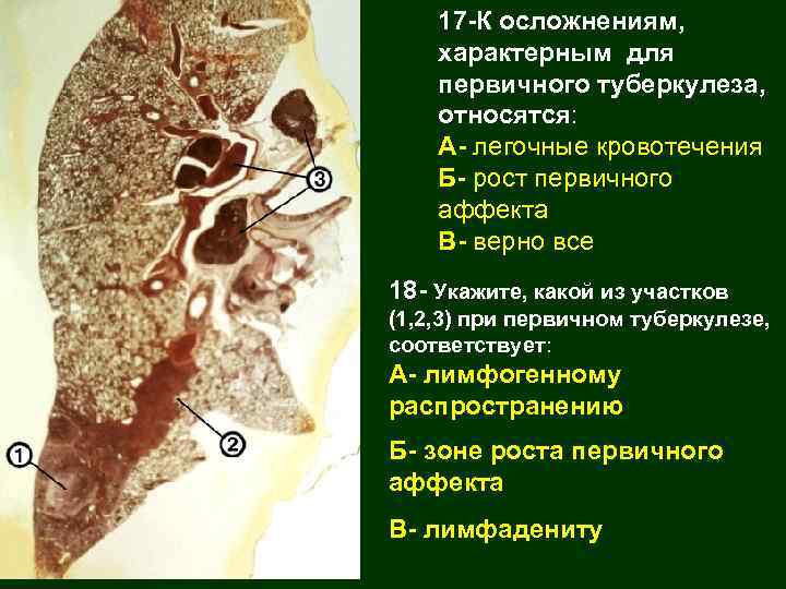 17 -К осложнениям, характерным для первичного туберкулеза, относятся: А- легочные кровотечения Б- рост первичного