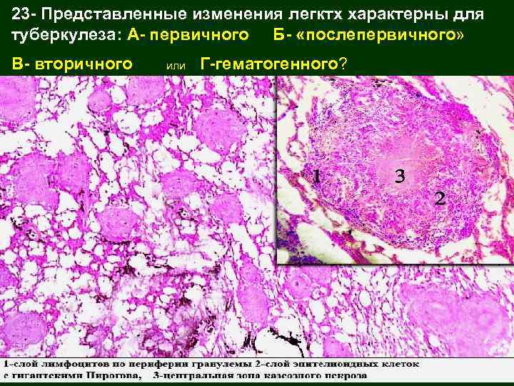 Стенка хронической туберкулезной каверны микропрепарат