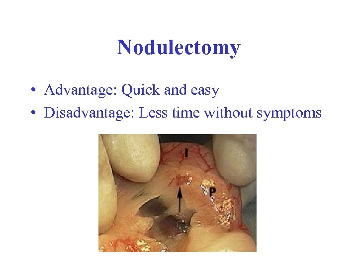 Nodulectomy • Advantage: Quick and easy • Disadvantage: Less time without symptoms 