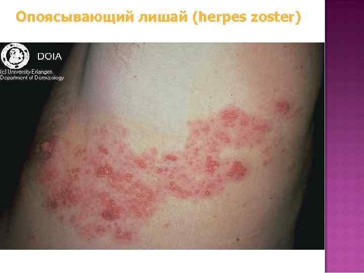 Опоясывающий лишай (herpes zoster) 