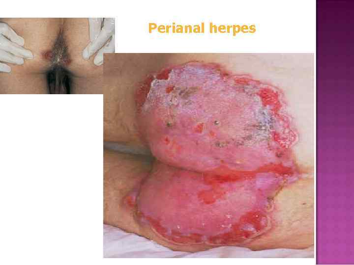 Perianal herpes 