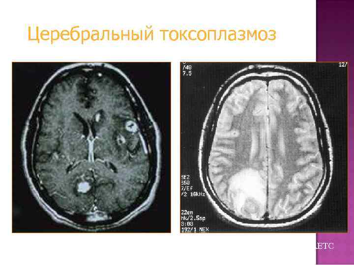 Церебральный токсоплазмоз Из коллекции слайдов UCHSC AETC 