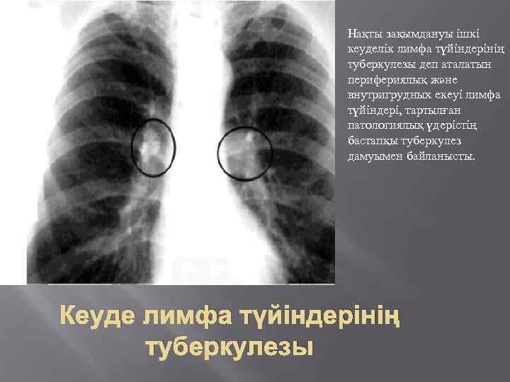 Нақты зақымдануы ішкі кеуделік лимфа түйіндерінің туберкулезы деп аталатын перифериялық және внутригрудных екеуі лимфа