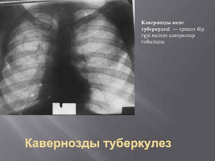 Кавернозды өкпе туберкулезі — ерекше бір түрі өкпеде каверналар табылады. Кавернозды туберкулез 