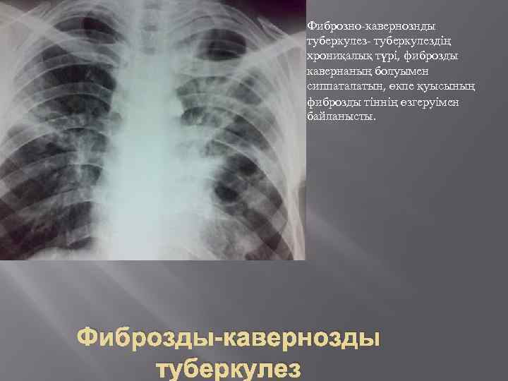 Фиброзно-кавернознды туберкулез- туберкулездің хрониқалық түрі, фиброзды кавернаның болуымен сиппаталатын, өкпе қуысының фиброзды тіннің өзгеруімен