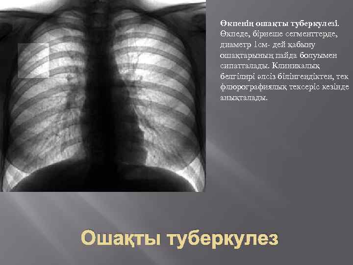 Өкпенің ошақты туберкулезі. Өкпеде, бірнеше сегменттерде, диаметр 1 см- дей қабыну ошақтарының пайда болуымен