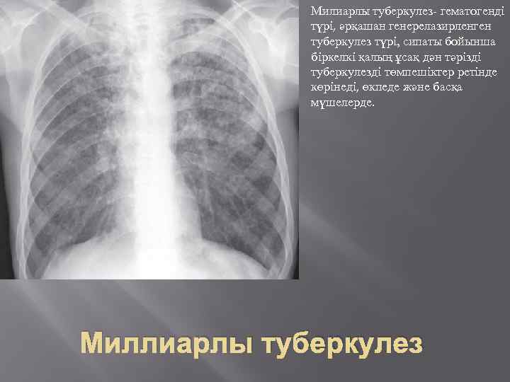 Милиарлы туберкулез- гематогенді түрі, әрқашан генерелазирленген туберкулез түрі, сипаты бойынша біркелкі қалың ұсақ дән