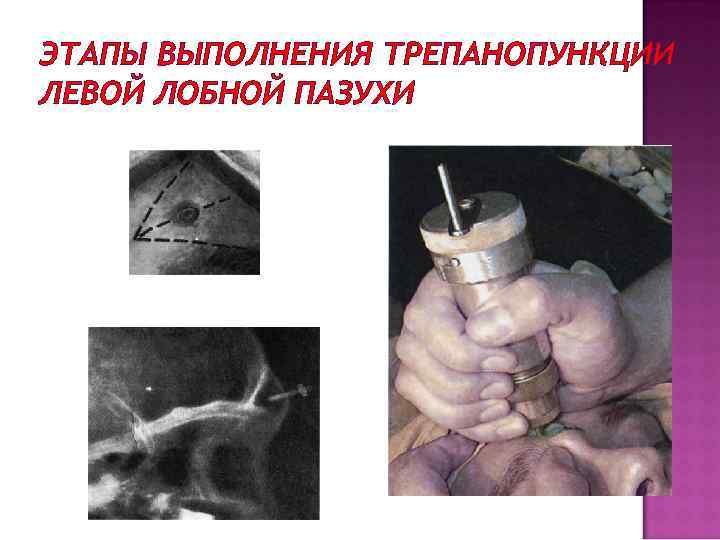 ЭТАПЫ ВЫПОЛНЕНИЯ ТРЕПАНОПУНКЦИИ ЛЕВОЙ ЛОБНОЙ ПАЗУХИ 