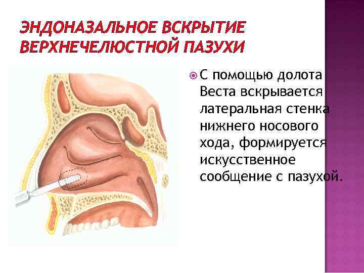 ЭНДОНАЗАЛЬНОЕ ВСКРЫТИЕ ВЕРХНЕЧЕЛЮСТНОЙ ПАЗУХИ С помощью долота Веста вскрывается латеральная стенка нижнего носового хода,