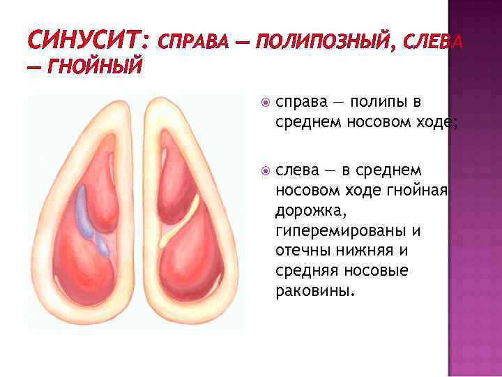 СИНУСИТ: СПРАВА — ПОЛИПОЗНЫЙ, СЛЕВА — ГНОЙНЫЙ справа — полипы в среднем носовом ходе;